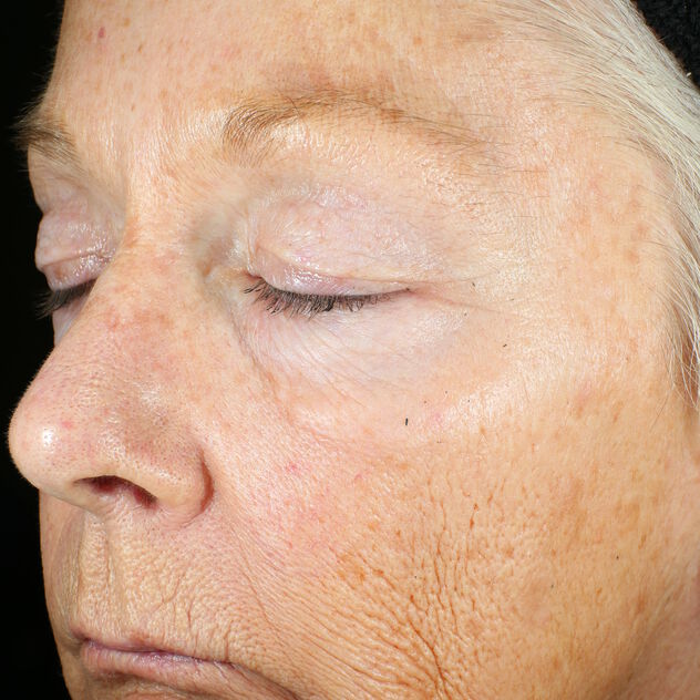 Wrinkle + Texture Repair before-after-1